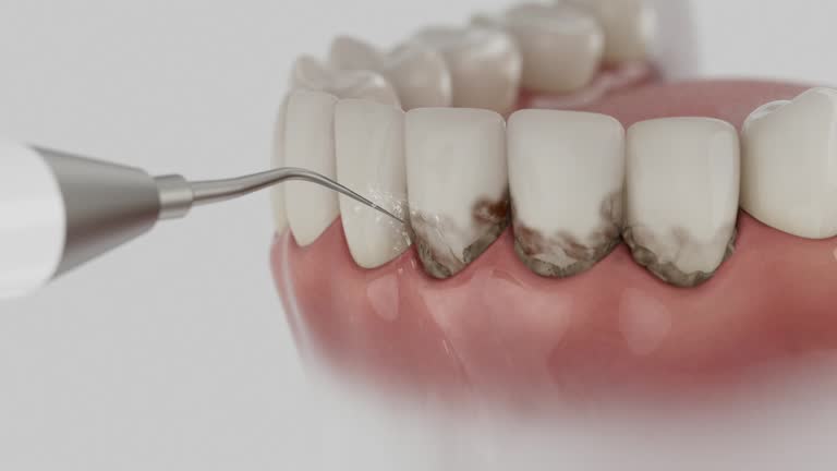 Trusted Wisdom Tooth Removal service in Mertzon, TX - Dentist Open Now